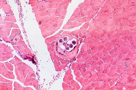 Roundworms in humans